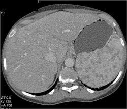 Sarcoidosis - CTisus CT Scan