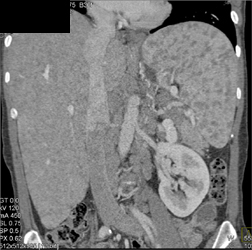 Sarcoidosis - CTisus CT Scan