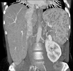 Sarcoidosis - CTisus CT Scan