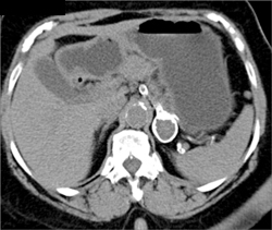 Splenic Artery Aneurysm - CTisus CT Scan