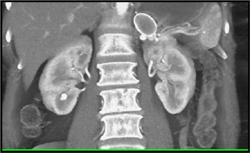 Splenic Artery Aneurysm - CTisus CT Scan