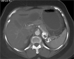 Splenic Artery Aneurysm - CTisus CT Scan