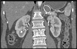 Splenic Artery Aneurysm - CTisus CT Scan