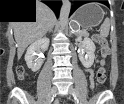 Splenic Artery Aneurysm - CTisus CT Scan