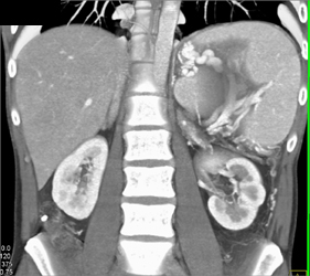 Splenic Vein Occlusion By Pancreatic Pseudocyst - CTisus CT Scan