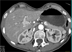 Accessory Spleen Vs Islet Cell - CTisus CT Scan