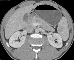 Splenic Abscess - CTisus CT Scan