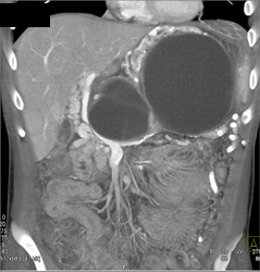 Splenic Vein Occlusion - CTisus CT Scan