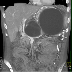 Pseudocysts Compress the Splenic Vein With Collaterals and Varices - CTisus CT Scan