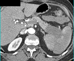 Splenic Invasion By Carcinoma of the Tail of the Pancreas - CTisus CT Scan