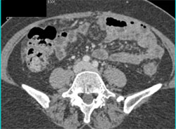 Carcinomatosis Due to Pancreatic Cancer - CTisus CT Scan