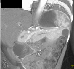 Splenic Cyst - CTisus CT Scan