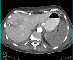 Infarcted Spleen and Hepatic Infarct - CTisus CT Scan