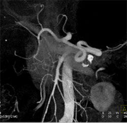 Splenic Artery Is Tortuous - CTisus CT Scan