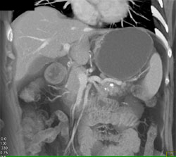 Calcified Lesion in Pancreas With Normal Splenic Artery - CTisus CT Scan