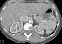 Splenic Lymphoma - CTisus CT Scan