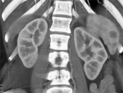 Splenic Lymphoma - CTisus CT Scan