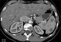 Splenic Lymphoma - CTisus CT Scan