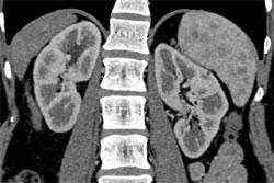 Splenic Lymphoma - CTisus CT Scan