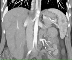 Splenic Lymphoma - CTisus CT Scan