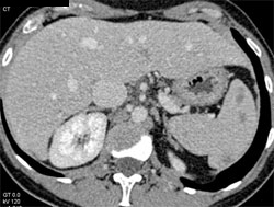 Splenic Lymphoma - CTisus CT Scan