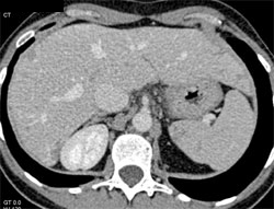 Splenic Lymphoma - CTisus CT Scan