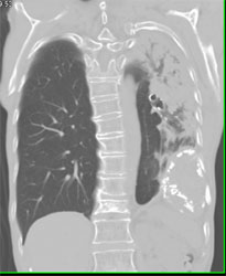 Calcified Pleura Near Diaphragm - CTisus CT Scan