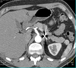 Accessory Spleen Near Tail of the Pancreas - CTisus CT Scan