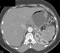 Sickle Cell Disease - CTisus CT Scan