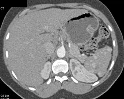 Sickle Cell Disease - CTisus CT Scan