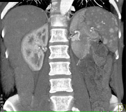 Sickle Cell Disease - CTisus CT Scan