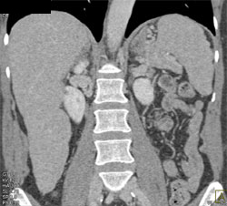 Sickle Cell Disease - CTisus CT Scan