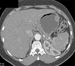 Sickle Cell Disease - CTisus CT Scan