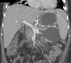 Pancreatic Pseudocysts Compress the Splenic Vein - CTisus CT Scan