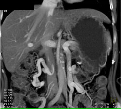 Extensive Collaterals Due to Splenic Vein Occlusion - CTisus CT Scan