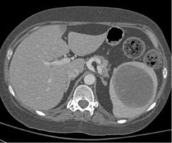 Epidermoid Cyst of the Spleen - CTisus CT Scan