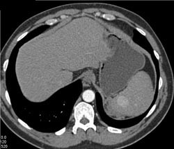 Splenic Hemangioma - CTisus CT Scan