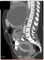 Pancreatic Pseudocyst Compresses the Spleen - CTisus CT Scan