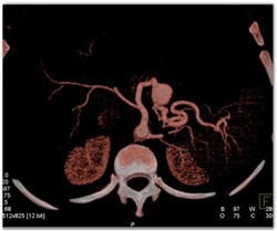 Splenic Artery Aneurysm - CTisus CT Scan