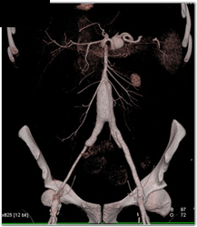 Splenic Artery Aneurysm - CTisus CT Scan