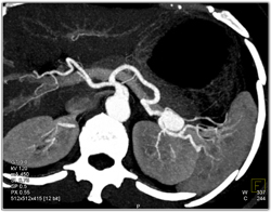 Splenic Artery Aneurysm - CTisus CT Scan