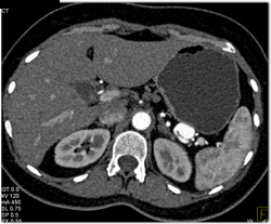 Splenic Artery Aneurysm - CTisus CT Scan