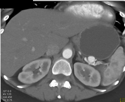 Splenic Artery Aneurysm - CTisus CT Scan