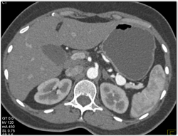 Splenic Artery Aneurysm - CTisus CT Scan