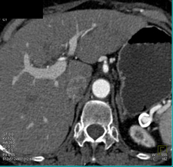 Splenic Artery Aneurysm - CTisus CT Scan