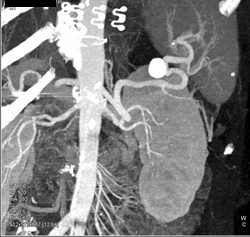 Splenic Artery Aneurysm - CTisus CT Scan