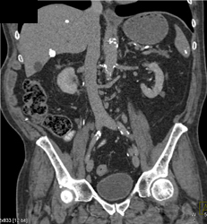 Granulomatous Disease Spleen and Liver - CTisus CT Scan