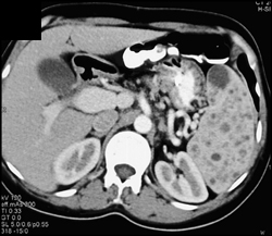 Splenic Sarcoidosis - CTisus CT Scan