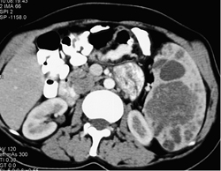 Splenic Hamangiomas in Klippel-Trenaunay-Weber (KTW) Syndrome - CTisus CT Scan