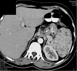 Sarcoidosis - CTisus CT Scan